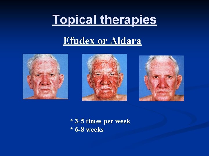 Topical therapies Efudex or Aldara * 3 -5 times per week * 6 -8