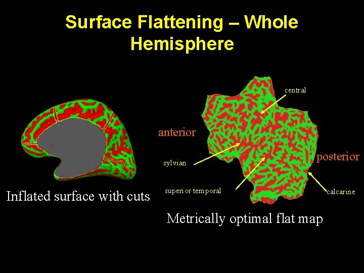 Surface Flattening – Whole Hemisphere central anterior sylvian Inflated surface with cuts posterior superior