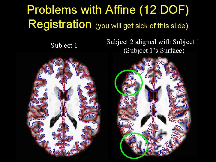 Problems with Affine (12 DOF) Registration (you will get sick of this slide) Subject
