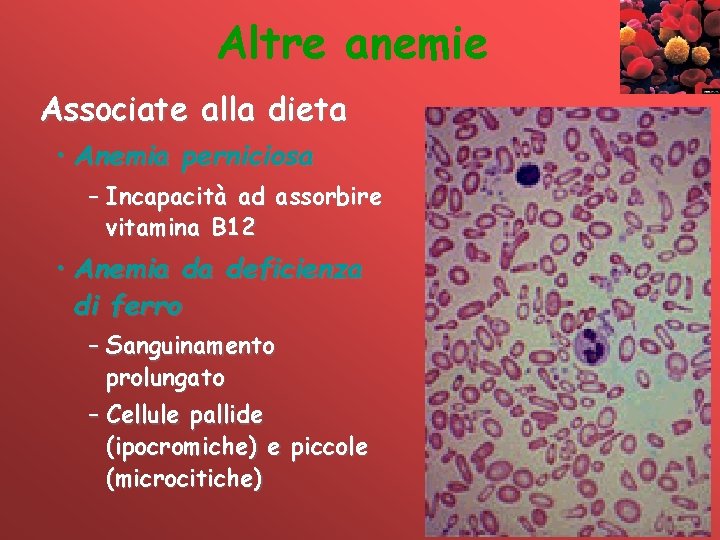 Altre anemie Associate alla dieta • Anemia perniciosa – Incapacità ad assorbire vitamina B