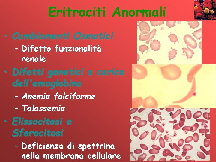 Eritrociti Anormali • Cambiamenti Osmotici – Difetto funzionalità renale • Difetti genetici a carico