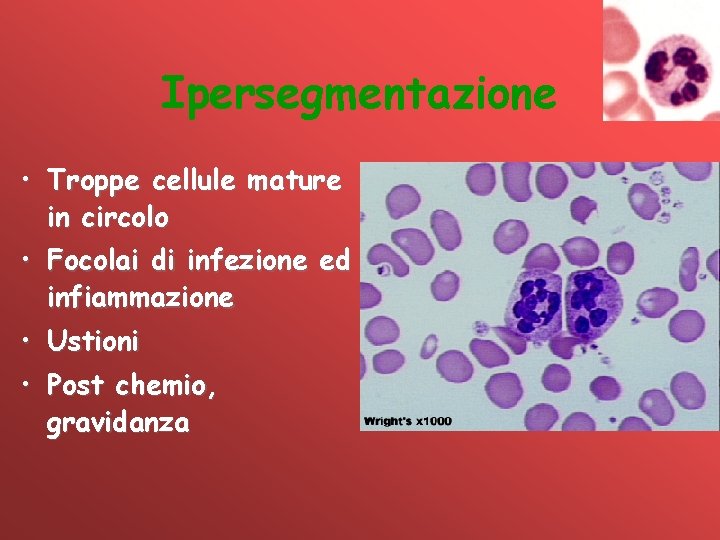 Ipersegmentazione • Troppe cellule mature in circolo • Focolai di infezione ed infiammazione •