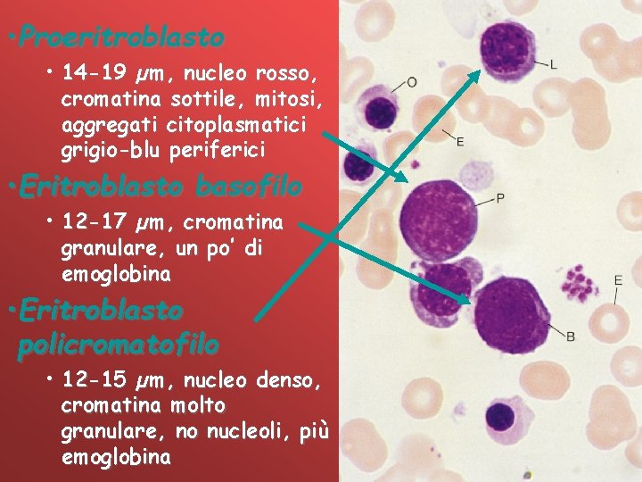  • Proeritroblasto • 14 -19 µm, nucleo rosso, cromatina sottile, mitosi, aggregati citoplasmatici
