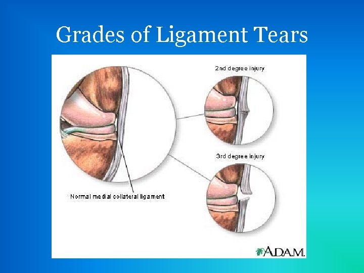 Grades of Ligament Tears 