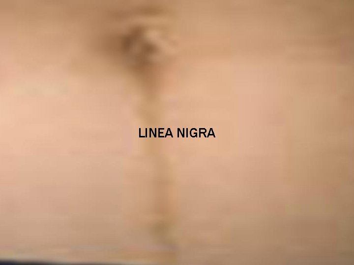 LINEA NIGRA 