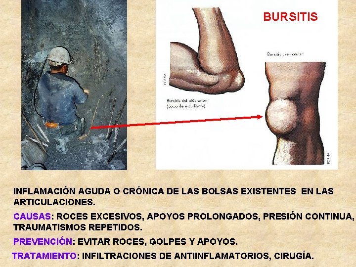 BURSITIS INFLAMACIÓN AGUDA O CRÓNICA DE LAS BOLSAS EXISTENTES EN LAS ARTICULACIONES. CAUSAS: ROCES