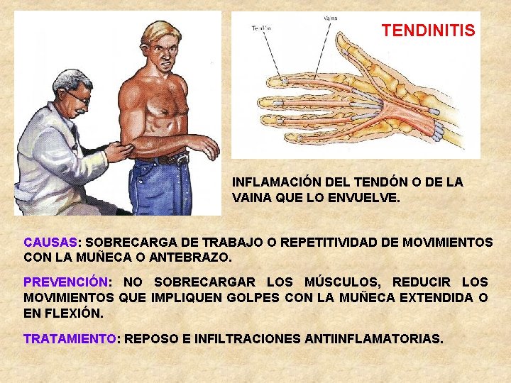 TENDINITIS INFLAMACIÓN DEL TENDÓN O DE LA VAINA QUE LO ENVUELVE. CAUSAS: SOBRECARGA DE