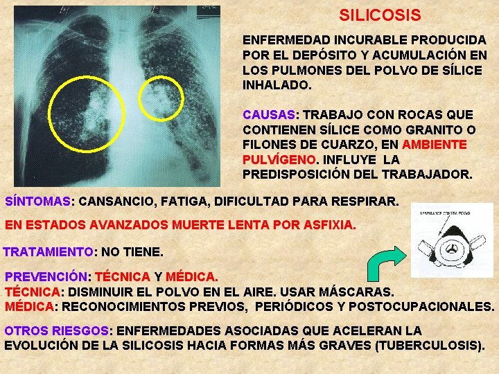 SILICOSIS ENFERMEDAD INCURABLE PRODUCIDA POR EL DEPÓSITO Y ACUMULACIÓN EN LOS PULMONES DEL POLVO