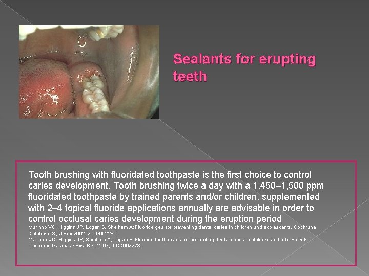 Sealants for erupting teeth Tooth brushing with fluoridated toothpaste is the first choice to