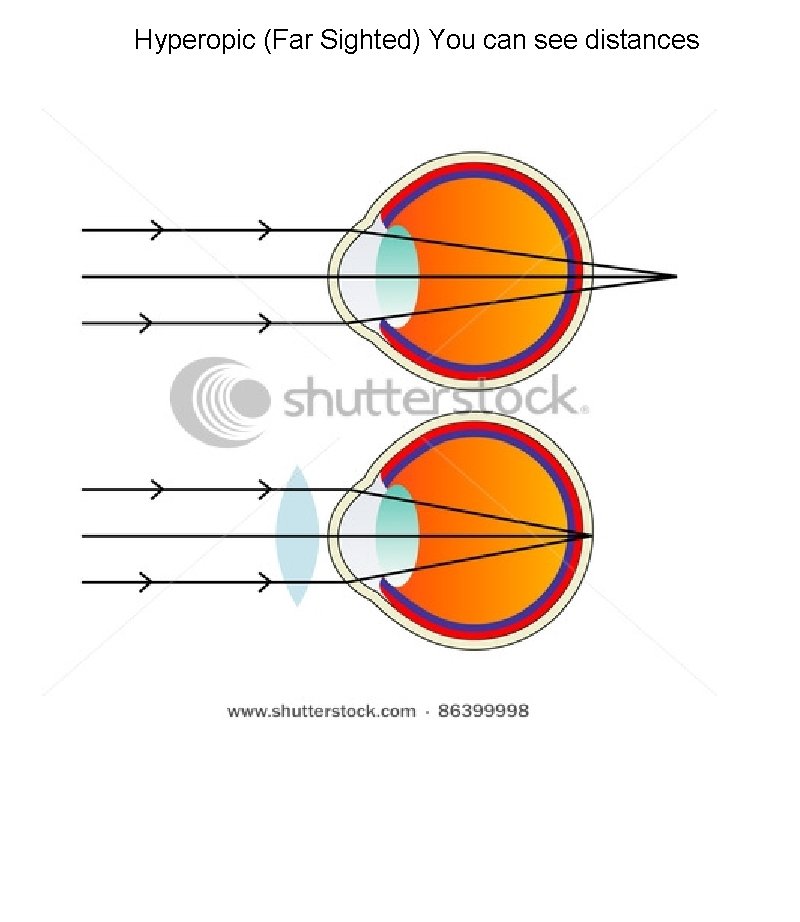 Hyperopic (Far Sighted) You can see distances 