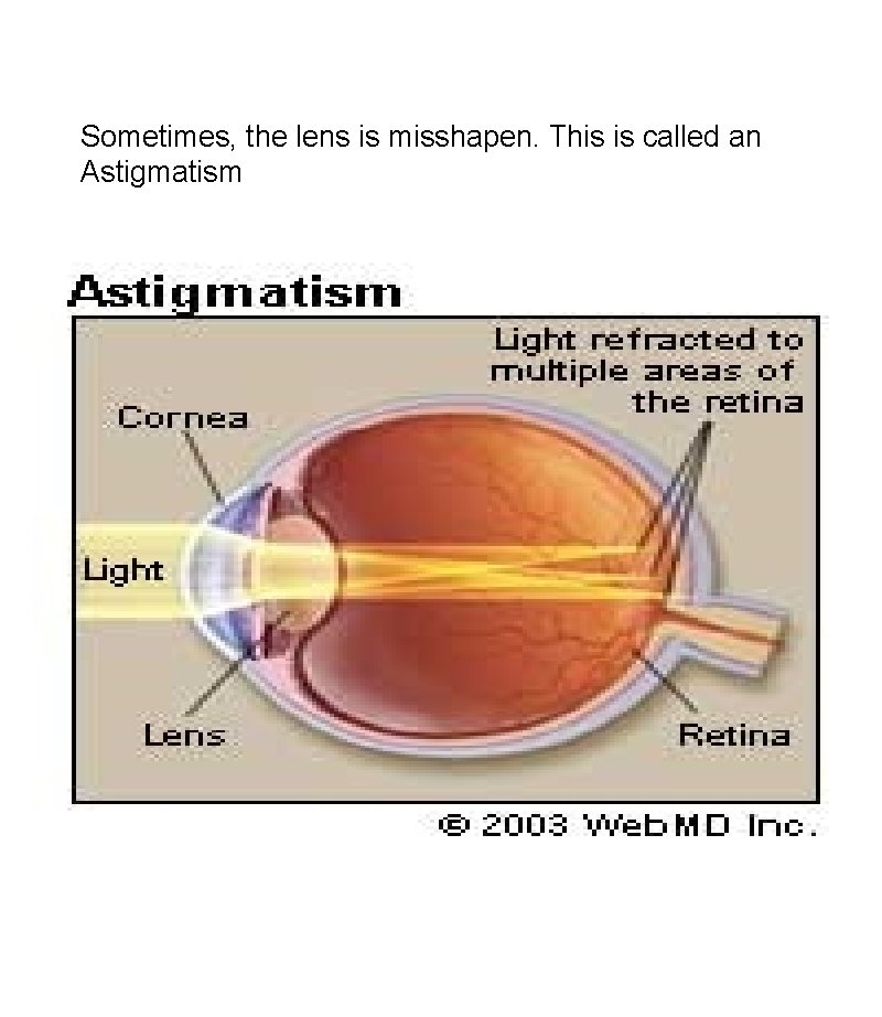Sometimes, the lens is misshapen. This is called an Astigmatism 