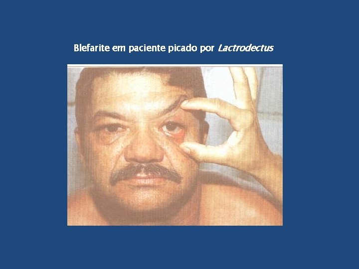 Blefarite em paciente picado por Lactrodectus 