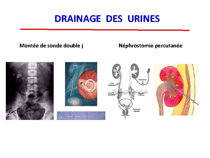 DRAINAGE DES URINES Montée de sonde double j Néphrostomie percutanée 