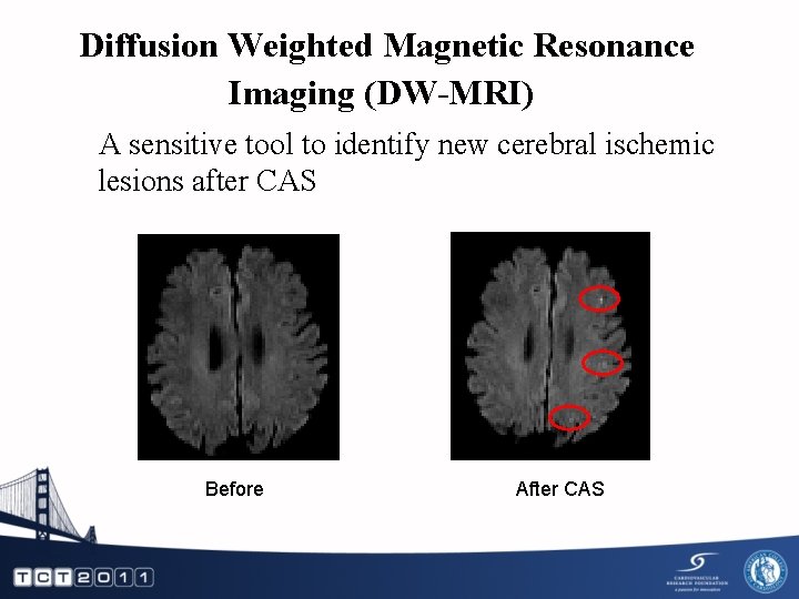 Diffusion Weighted Magnetic Resonance Imaging (DW-MRI) A sensitive tool to identify new cerebral ischemic