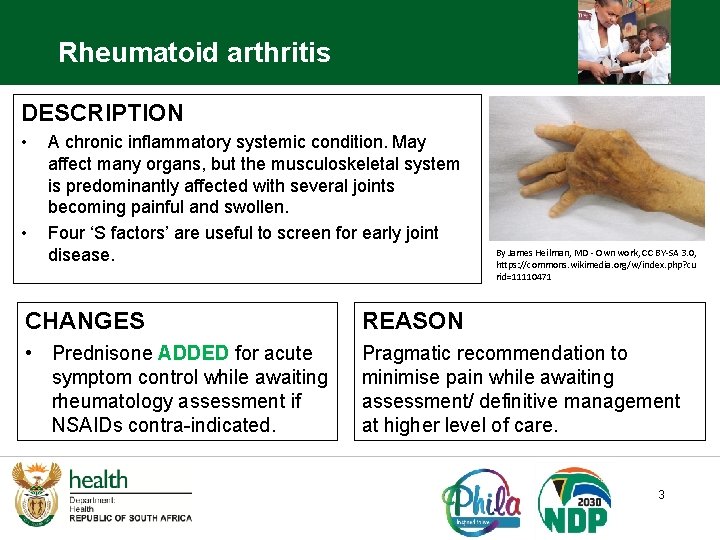 Rheumatoid arthritis DESCRIPTION • • A chronic inflammatory systemic condition. May affect many organs,