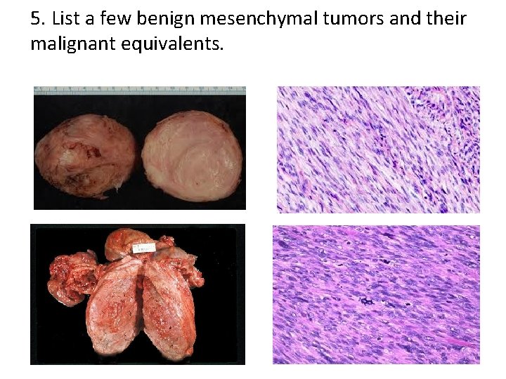 5. List a few benign mesenchymal tumors and their malignant equivalents. 5. List a few benign mesenchymal tumors and their malignant equivalents.
