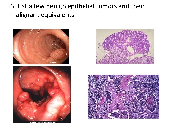 6. List a few benign epithelial tumors and their malignant equivalents. 6. List a few benign epithelial tumors and their malignant equivalents.