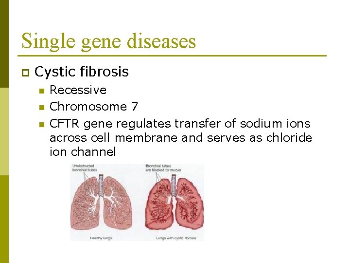 Single gene diseases p Cystic fibrosis n n n Recessive Chromosome 7 CFTR gene