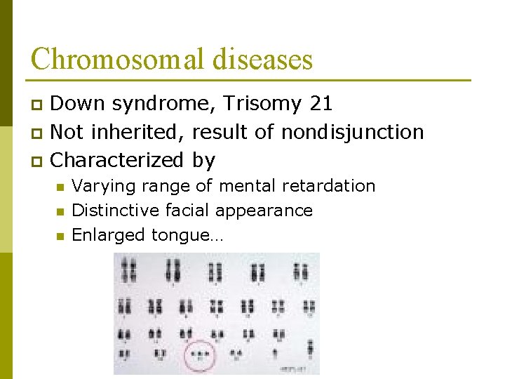 Chromosomal diseases Down syndrome, Trisomy 21 p Not inherited, result of nondisjunction p Characterized