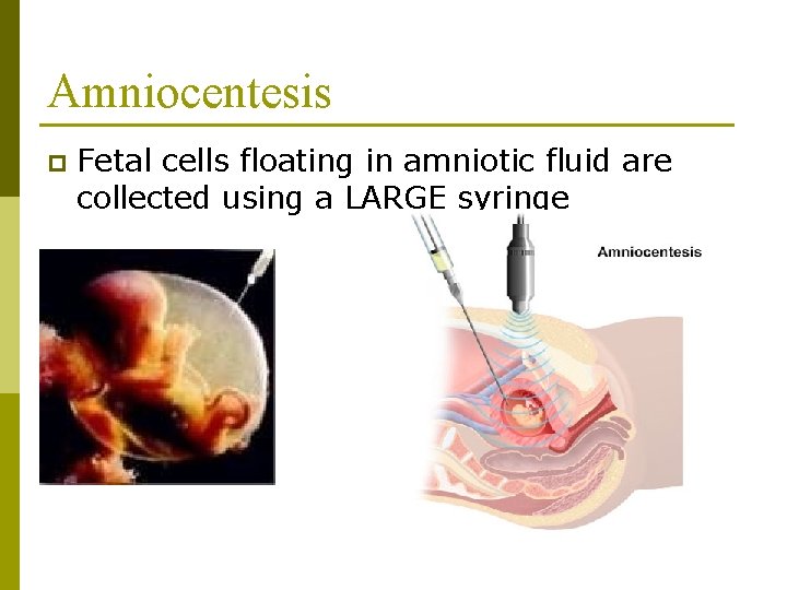 Amniocentesis p Fetal cells floating in amniotic fluid are collected using a LARGE syringe