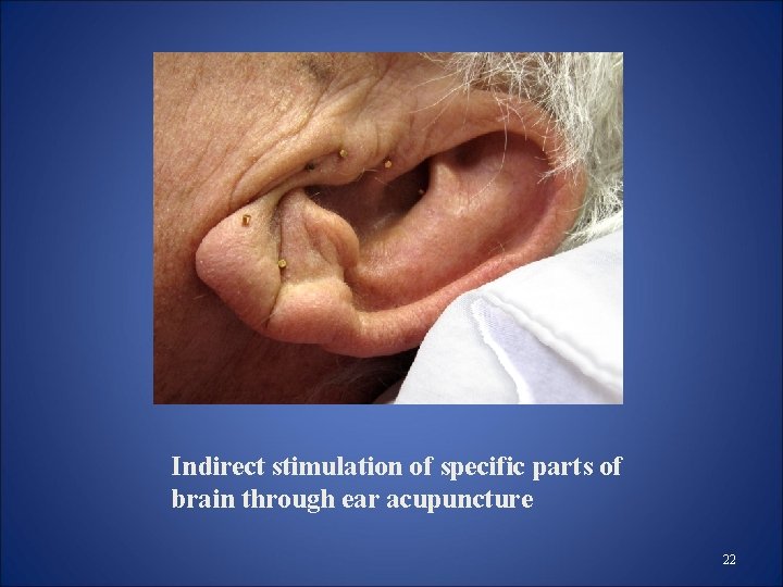 Indirect stimulation of specific parts of brain through ear acupuncture 22 Indirect stimulation of specific parts of brain through ear acupuncture 22
