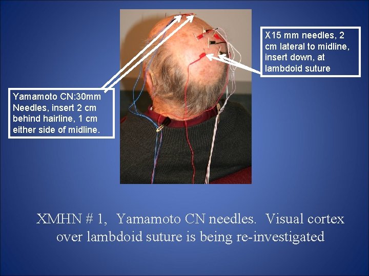 X 15 mm needles, 2 cm lateral to midline, insert down, at lambdoid suture X 15 mm needles, 2 cm lateral to midline, insert down, at lambdoid suture