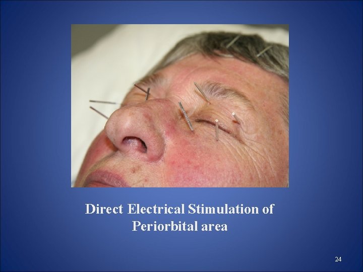Direct Electrical Stimulation of Periorbital area 24 Direct Electrical Stimulation of Periorbital area 24