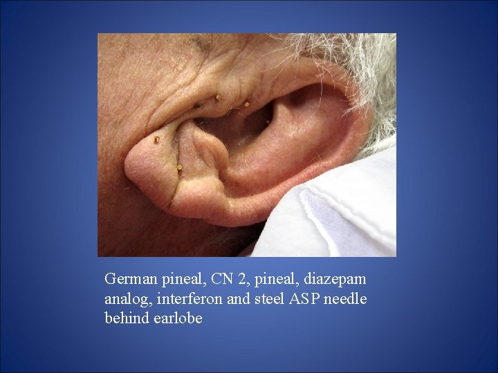 German pineal, CN 2, pineal, diazepam analog, interferon and steel ASP needle behind earlobe German pineal, CN 2, pineal, diazepam analog, interferon and steel ASP needle behind earlobe