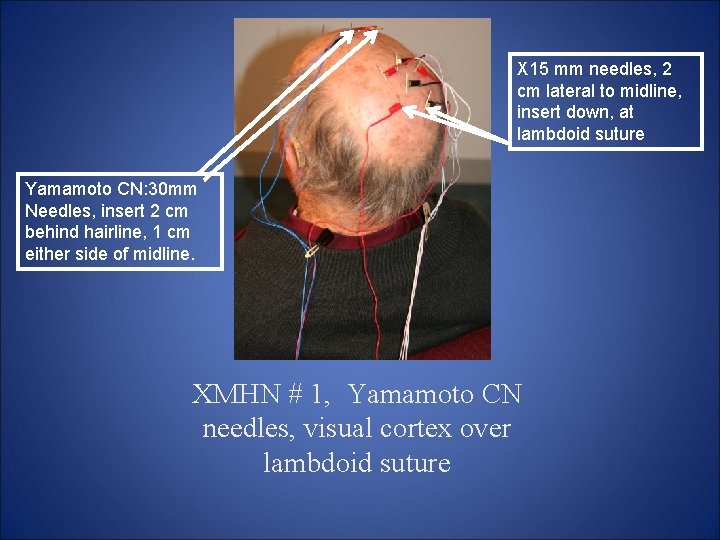 X 15 mm needles, 2 cm lateral to midline, insert down, at lambdoid suture X 15 mm needles, 2 cm lateral to midline, insert down, at lambdoid suture