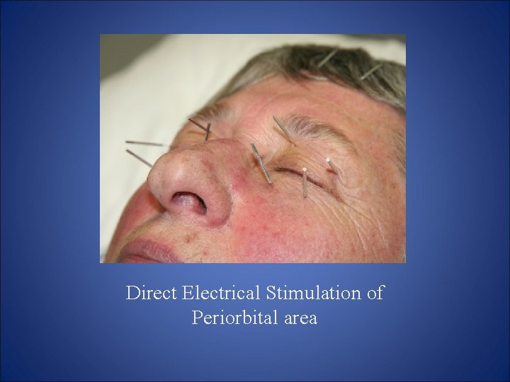 Direct Electrical Stimulation of Periorbital area Direct Electrical Stimulation of Periorbital area