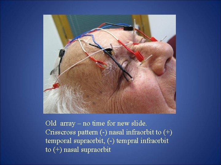 Old array – no time for new slide. Crisscross pattern (-) nasal infraorbit to Old array – no time for new slide. Crisscross pattern (-) nasal infraorbit to