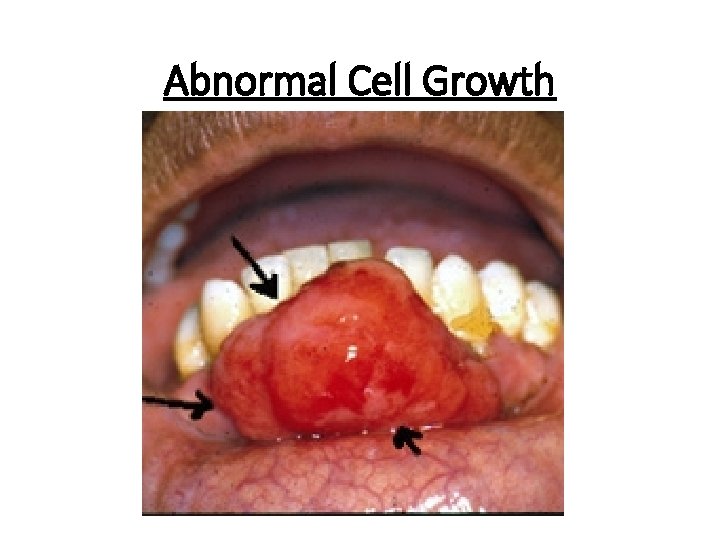 Abnormal Cell Growth 