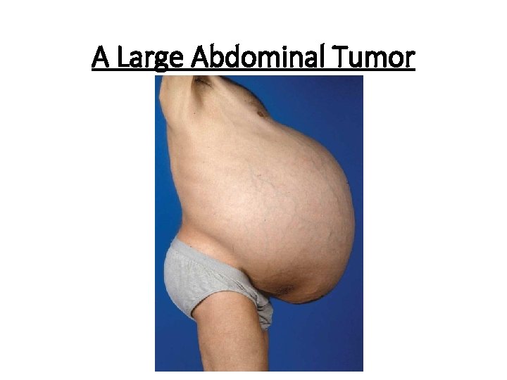 A Large Abdominal Tumor 