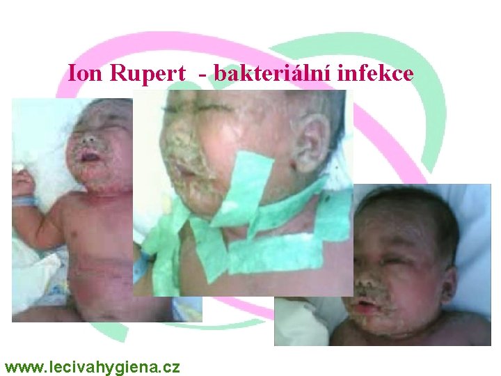 Ion Rupert - bakteriální infekce www. lecivahygiena. cz 