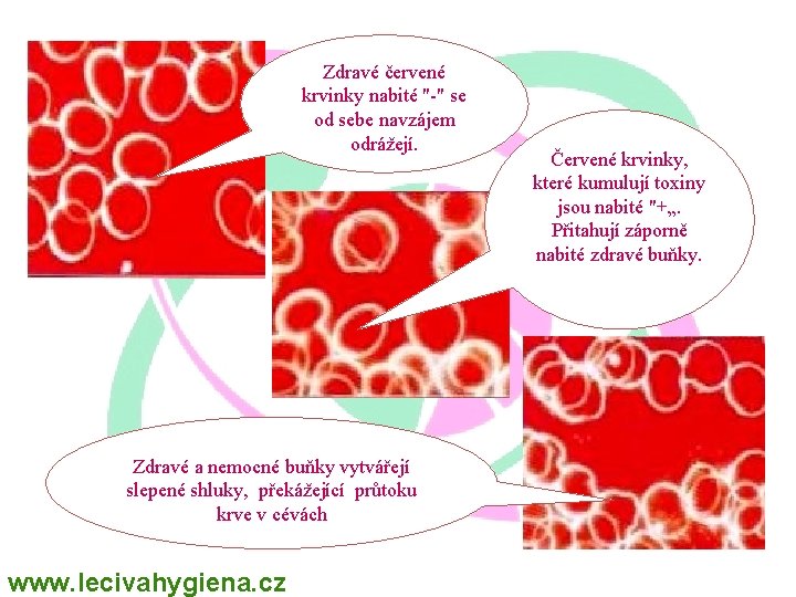 Zdravé červené krvinky nabité "-" se od sebe navzájem odrážejí. Zdravé a nemocné buňky