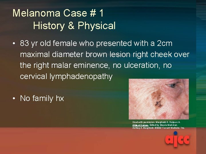 Melanoma Case # 1 History & Physical • 83 yr old female who presented