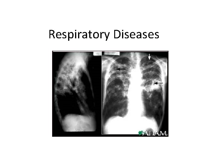 Respiratory Diseases 