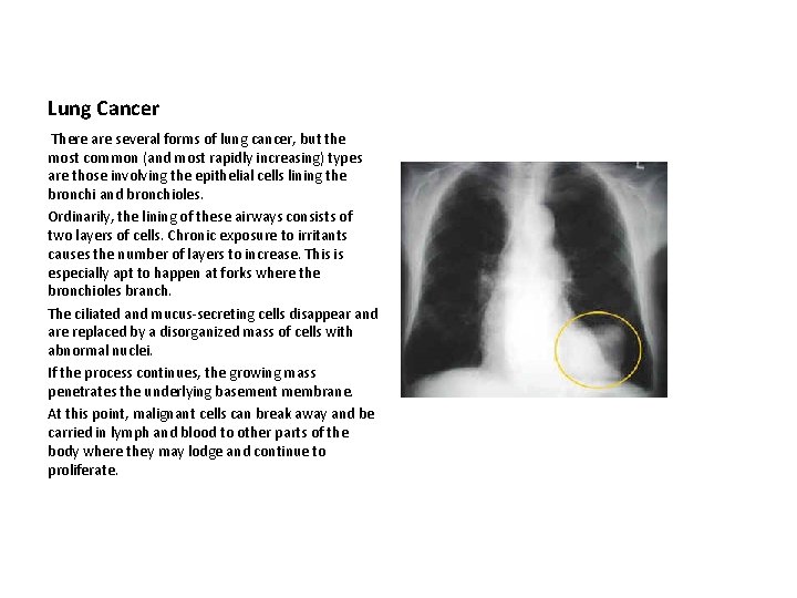 Lung Cancer There are several forms of lung cancer, but the most common (and