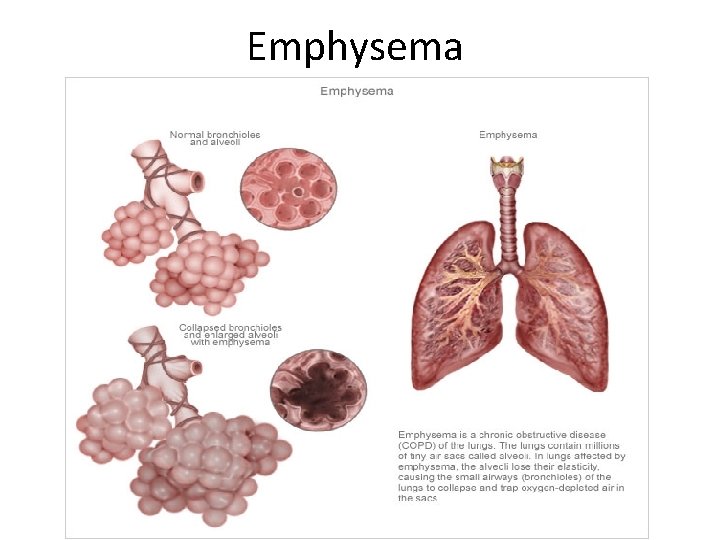 Emphysema 