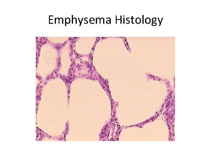 Emphysema Histology 