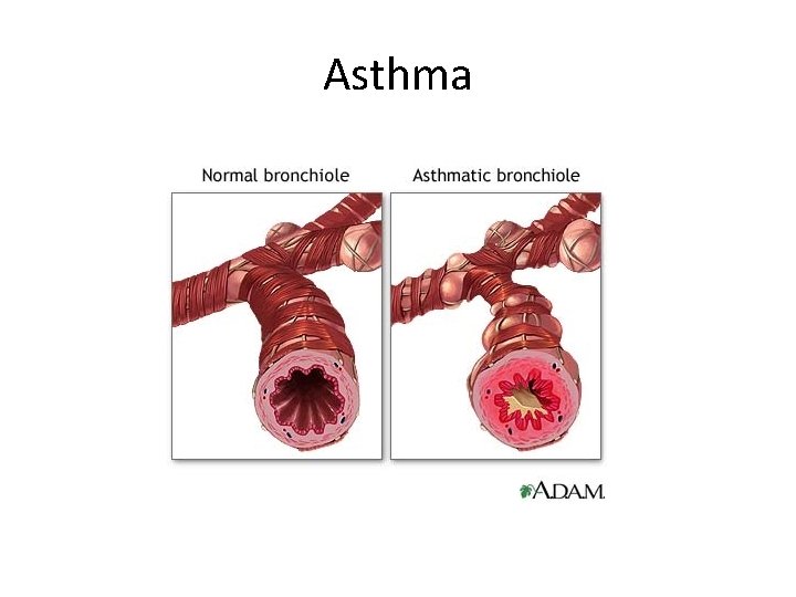 Asthma 