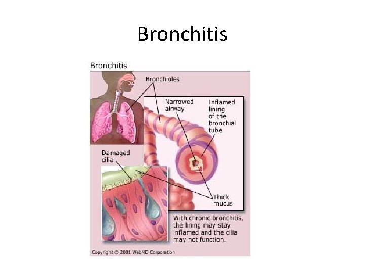 Bronchitis 