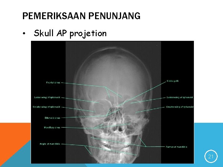 PEMERIKSAAN PENUNJANG • Skull AP projetion 21 