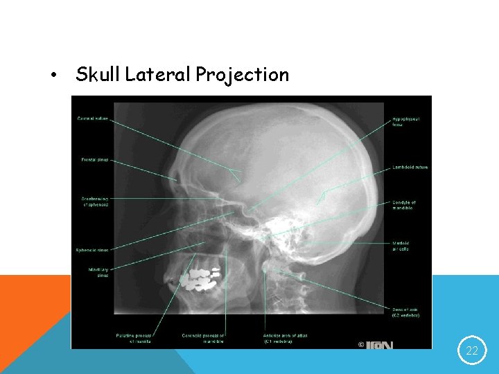  • Skull Lateral Projection 22 