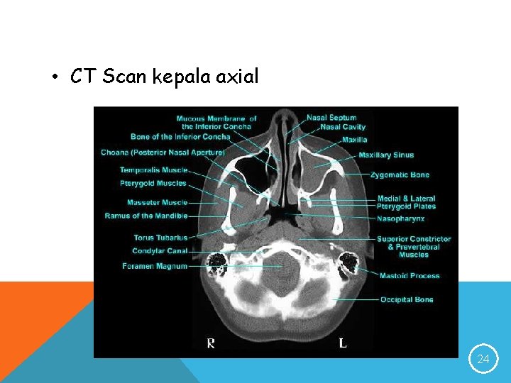  • CT Scan kepala axial 24 