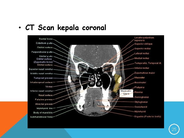  • CT Scan kepala coronal 25 