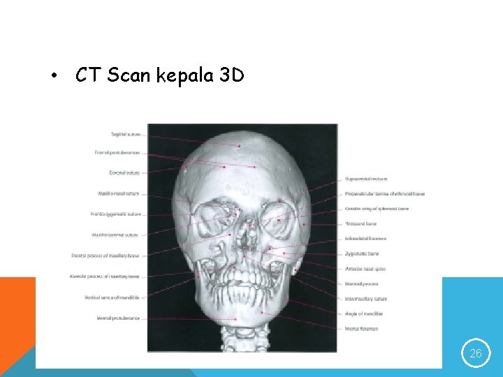  • CT Scan kepala 3 D 26 
