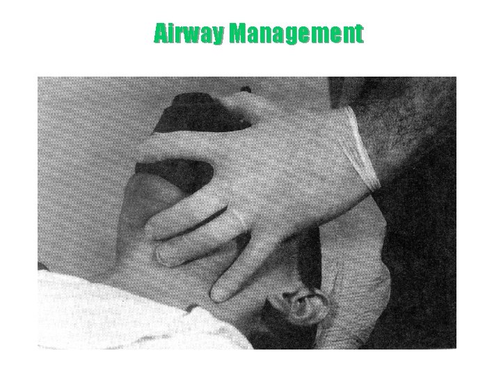 Airway Management 