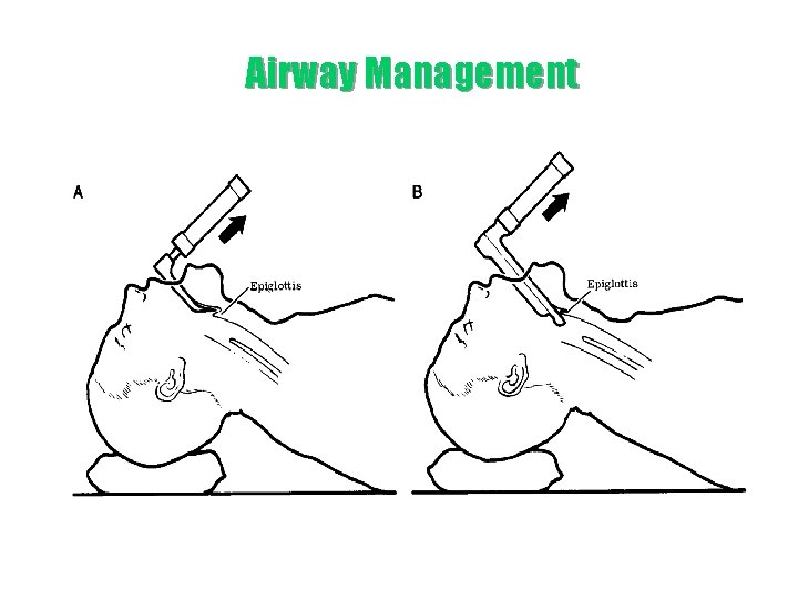 Airway Management 