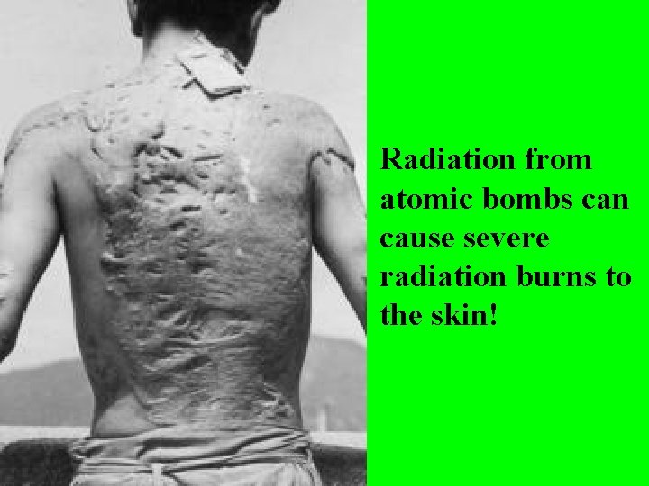 Radiation from atomic bombs can cause severe radiation burns to the skin! Radiation from atomic bombs can cause severe radiation burns to the skin!